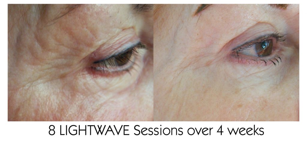Lightwave Eye Wrinkles